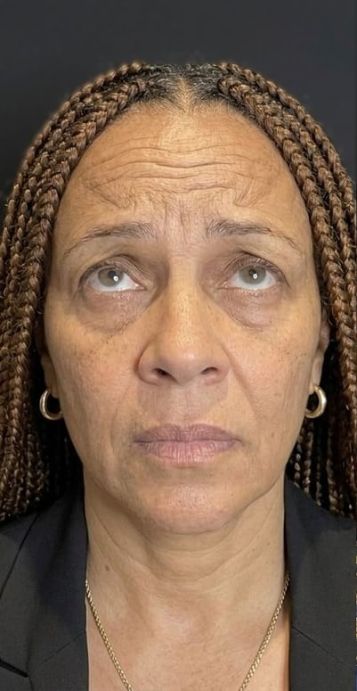 Antes — botox testa