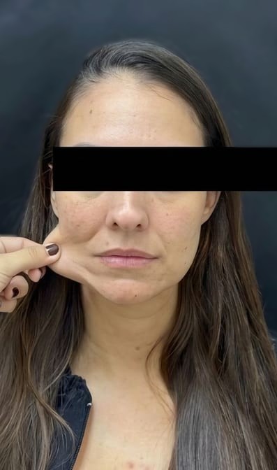 Antes — ultrassom microfocado