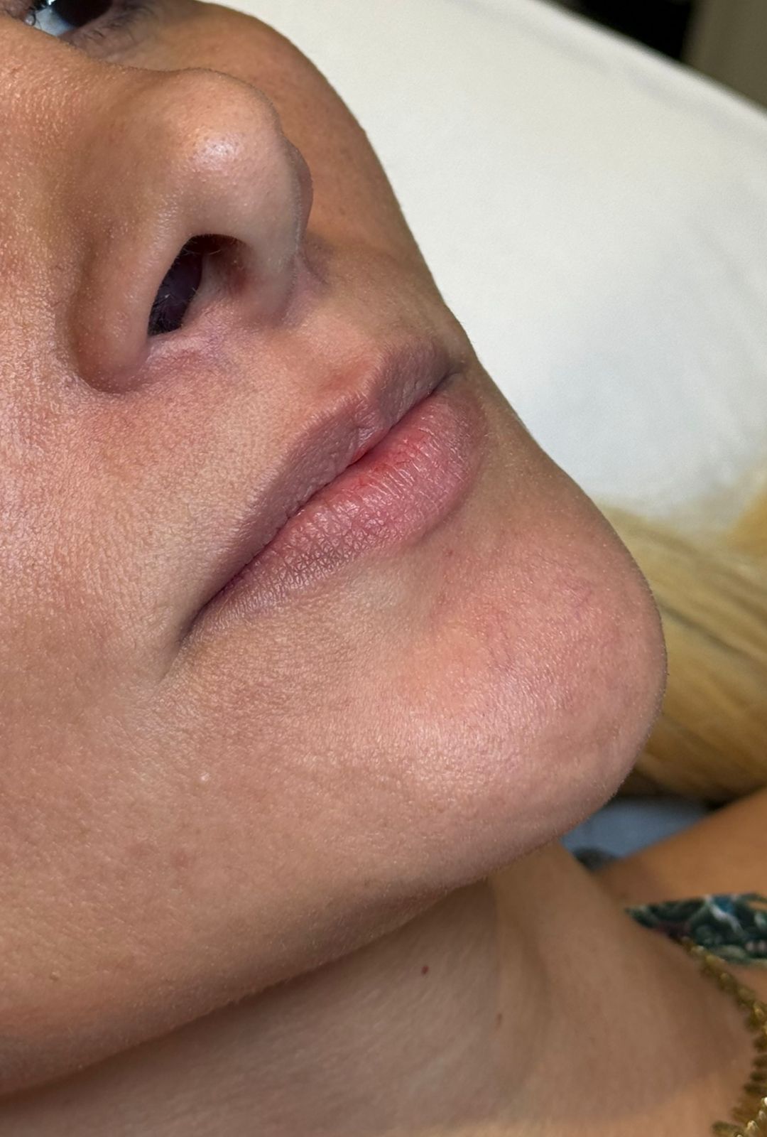 Antes — preenchimento labial