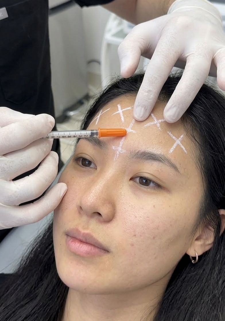 Aplicação de toxina botulínica Dysport com marcações — Botox 3 regiões na Vip Estetic Fortaleza