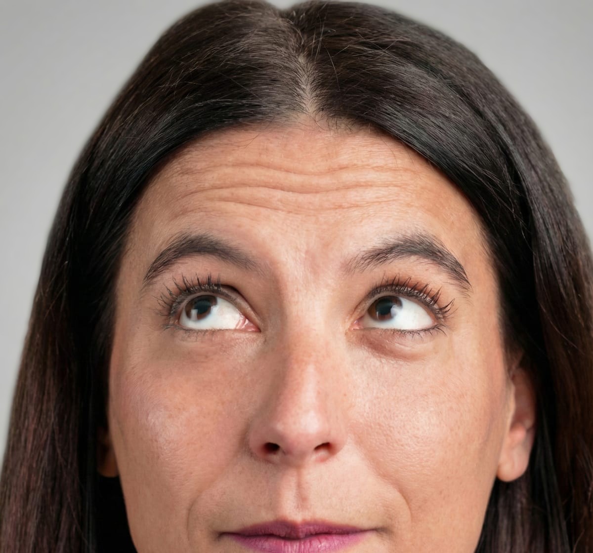 Toxina Botulínica Dysport — Vip Estetic