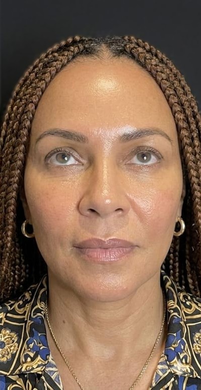 Depois — botox testa