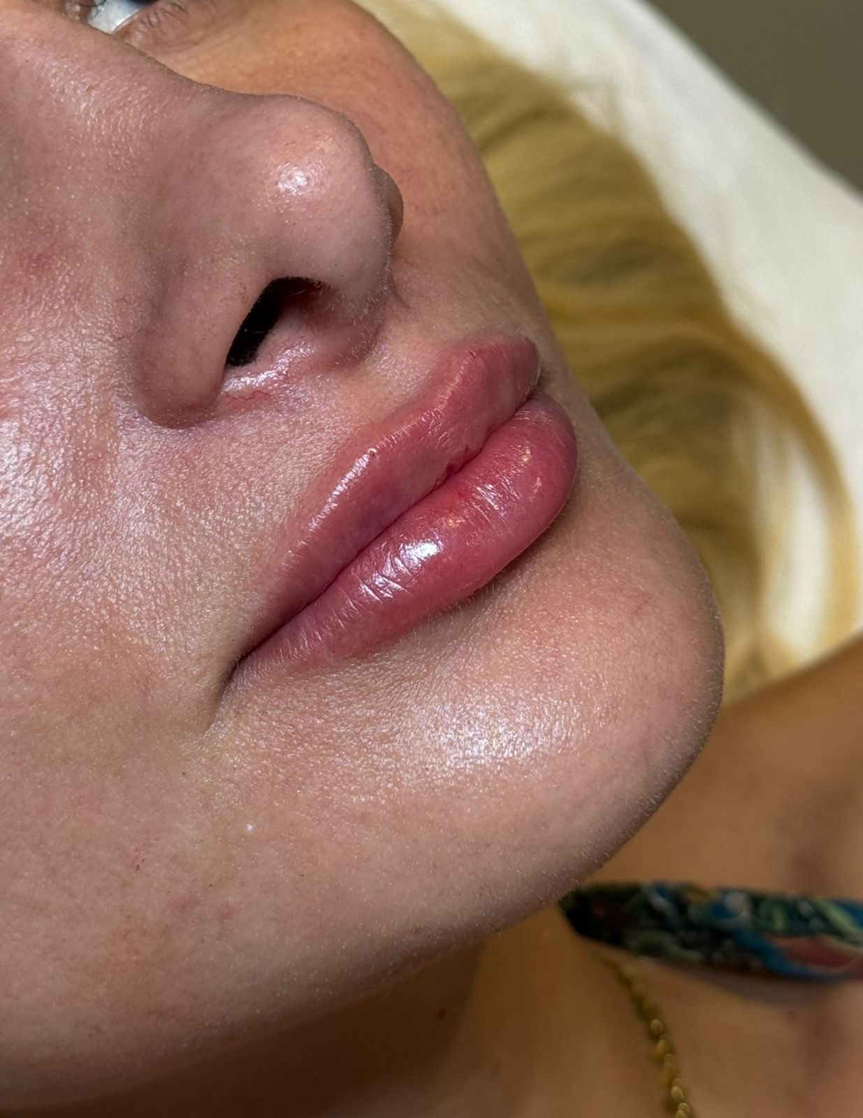 Depois — preenchimento labial