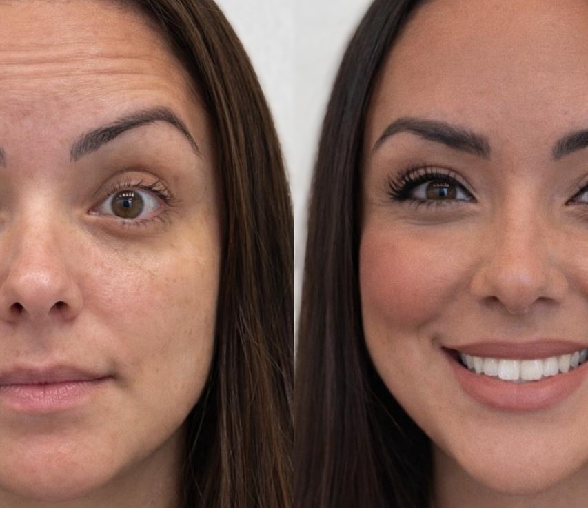 Antes e depois Botox — resultado natural — Vip Estetic Fortaleza